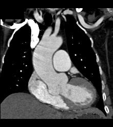 Dilated Sinuses of Valsalva in A Marfan Patient - CTisus CT Scan