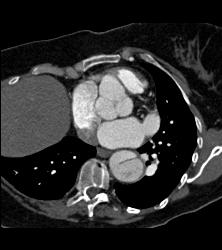 Dilated Sinuses of Valsalva in A Marfan Patient - CTisus CT Scan