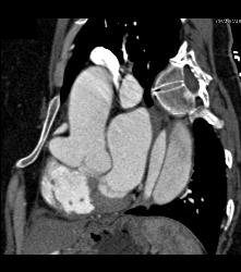 Dilated Sinuses of Valsalva in A Marfan Patient - CTisus CT Scan