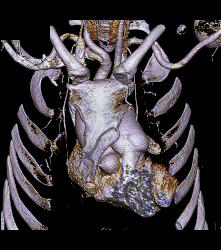 Dilated Sinuses of Valsalva in A Marfan Patient - CTisus CT Scan