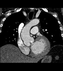 Bicuspid Valve - CTisus CT Scan