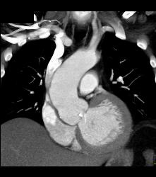 Bicuspid Valve - CTisus CT Scan