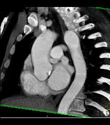 Bicuspid Valve - CTisus CT Scan