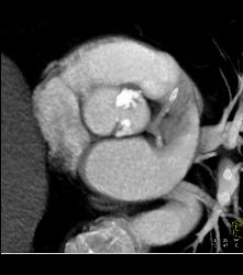 Bicuspid Valve - CTisus CT Scan