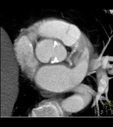 Bicuspid Valve - CTisus CT Scan