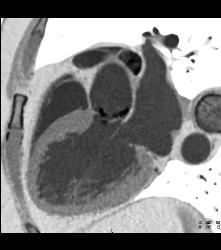 Bicuspid Valve - CTisus CT Scan