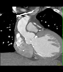 Bicuspid Valve - CTisus CT Scan