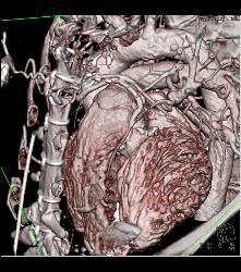 Multiple Bypass Grafts - CTisus CT Scan