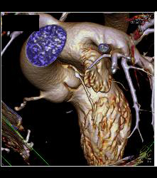 Left Anterior Descending Coronary Artery (LAD) Plaque - CTisus CT Scan