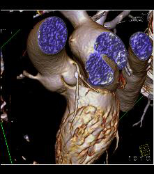 Left Anterior Descending Coronary Artery (LAD) Plaque - CTisus CT Scan