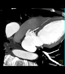 Left Anterior Descending Coronary Artery (LAD) Plaque - CTisus CT Scan