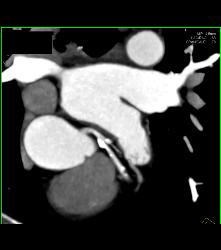 Left Anterior Descending Coronary Artery (LAD) Plaque - CTisus CT Scan