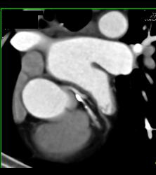 Left Anterior Descending Coronary Artery (LAD) Plaque - CTisus CT Scan