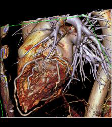 Normal RCA - CTisus CT Scan