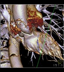 Normal RCA - CTisus CT Scan