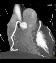 Normal RCA - CTisus CT Scan