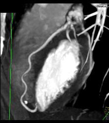 Normal RCA - CTisus CT Scan