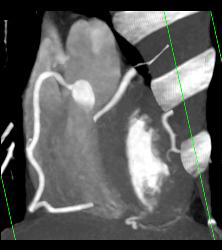 Normal RCA - CTisus CT Scan