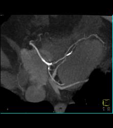 Right Dominant With Branching - CTisus CT Scan