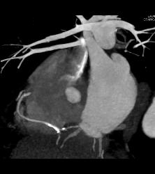 Right Dominant With Branching - CTisus CT Scan