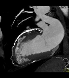 Extensive Left Anterior Descending Coronary Artery (LAD) Plaque - CTisus CT Scan