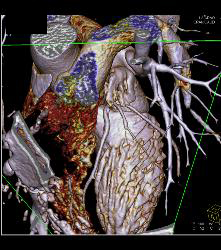 Minimal Left Anterior Descending Coronary Artery (LAD) Disease- See Full Sequence - CTisus CT Scan