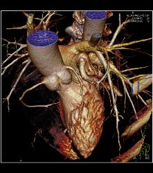 Minimal Left Anterior Descending Coronary Artery (LAD) Disease- See Full Sequence - CTisus CT Scan