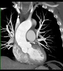 Minimal Left Anterior Descending Coronary Artery (LAD) Disease- See Full Sequence - CTisus CT Scan