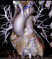 Minimal Left Anterior Descending Coronary Artery (LAD) Disease- See Full Sequence - CTisus CT Scan