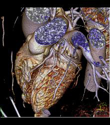 Normal Left Main Coronary Artery Trifurcation - CTisus CT Scan