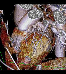 Normal Left Main Coronary Artery Trifurcation - CTisus CT Scan