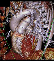 Normal Left Main Coronary Artery Trifurcation - CTisus CT Scan