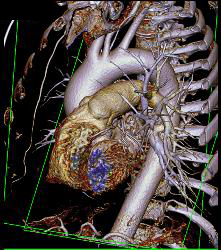 Normal Left Main Coronary Artery Trifurcation - CTisus CT Scan