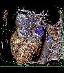 Normal Left Main Coronary Artery Trifurcation - CTisus CT Scan