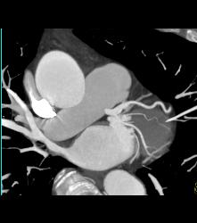 Normal Left Main Coronary Artery Trifurcation - CTisus CT Scan