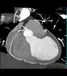 Conus Branch Off Right Cusp - CTisus CT Scan