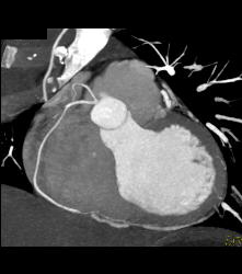 Conus Branch Off Right Cusp - CTisus CT Scan