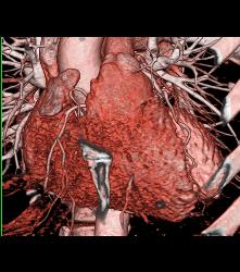 Conus Branch Off Right Cusp - CTisus CT Scan