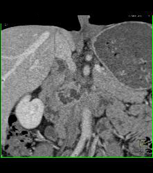 Incidental Intraductal Papillary Mucinous Neoplasm (IPMN) Seen on Aneurysm Study - CTisus CT Scan