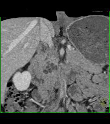 Incidental Intraductal Papillary Mucinous Neoplasm (IPMN) Seen on Aneurysm Study - CTisus CT Scan