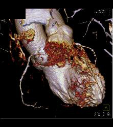 Left Anterior Descending Coronary Artery (LAD) and Right Coronary Artery (RCA) Disease - CTisus CT Scan