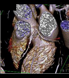 Left Anterior Descending Coronary Artery (LAD) and Right Coronary Artery (RCA) Disease - CTisus CT Scan