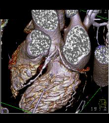 Left Anterior Descending Coronary Artery (LAD) and Right Coronary Artery (RCA) Disease - CTisus CT Scan