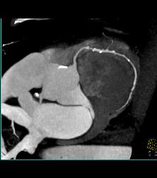 Left Anterior Descending Coronary Artery (LAD) and Right Coronary Artery (RCA) Disease - CTisus CT Scan