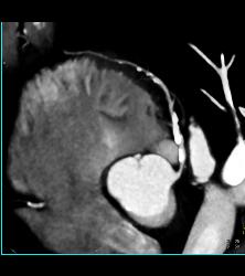 Left Anterior Descending Coronary Artery (LAD) and Right Coronary Artery (RCA) Disease - CTisus CT Scan