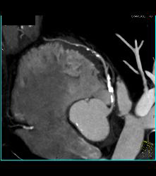 Left Anterior Descending Coronary Artery (LAD) and Right Coronary Artery (RCA) Disease - CTisus CT Scan