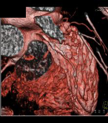 Left Anterior Descending Coronary Artery (LAD) and Right Coronary Artery (RCA) Disease - CTisus CT Scan