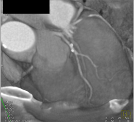 Calcified Plaque Without Stenosis - CTisus CT Scan