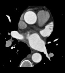 Normal Left Atrial Appendage - CTisus CT Scan