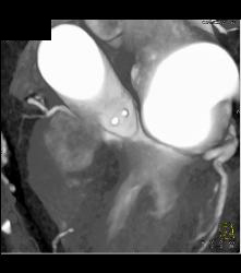 Left Anterior Descending Coronary Artery (LAD) and Circumflex Arise Directly Off the Left Cusp - CTisus CT Scan